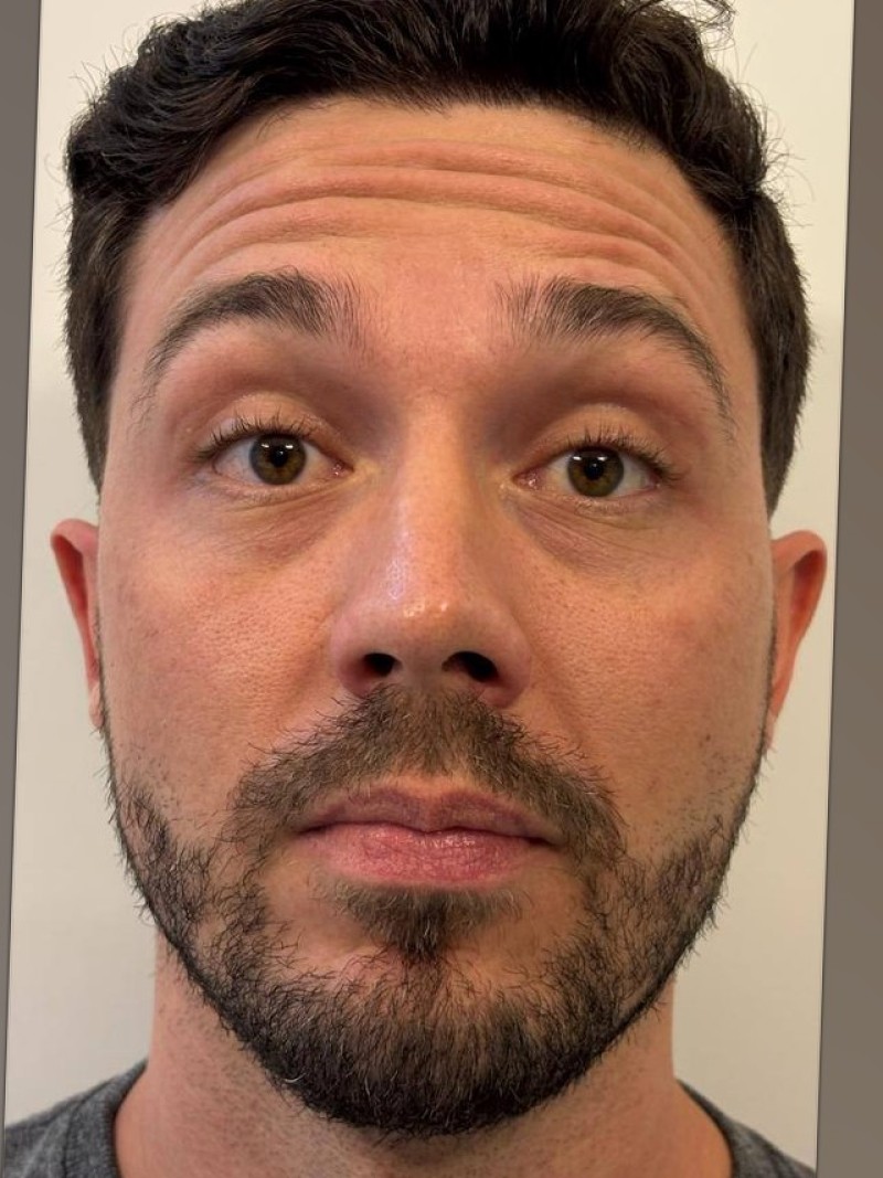 Antes e depois, caso 2, antes