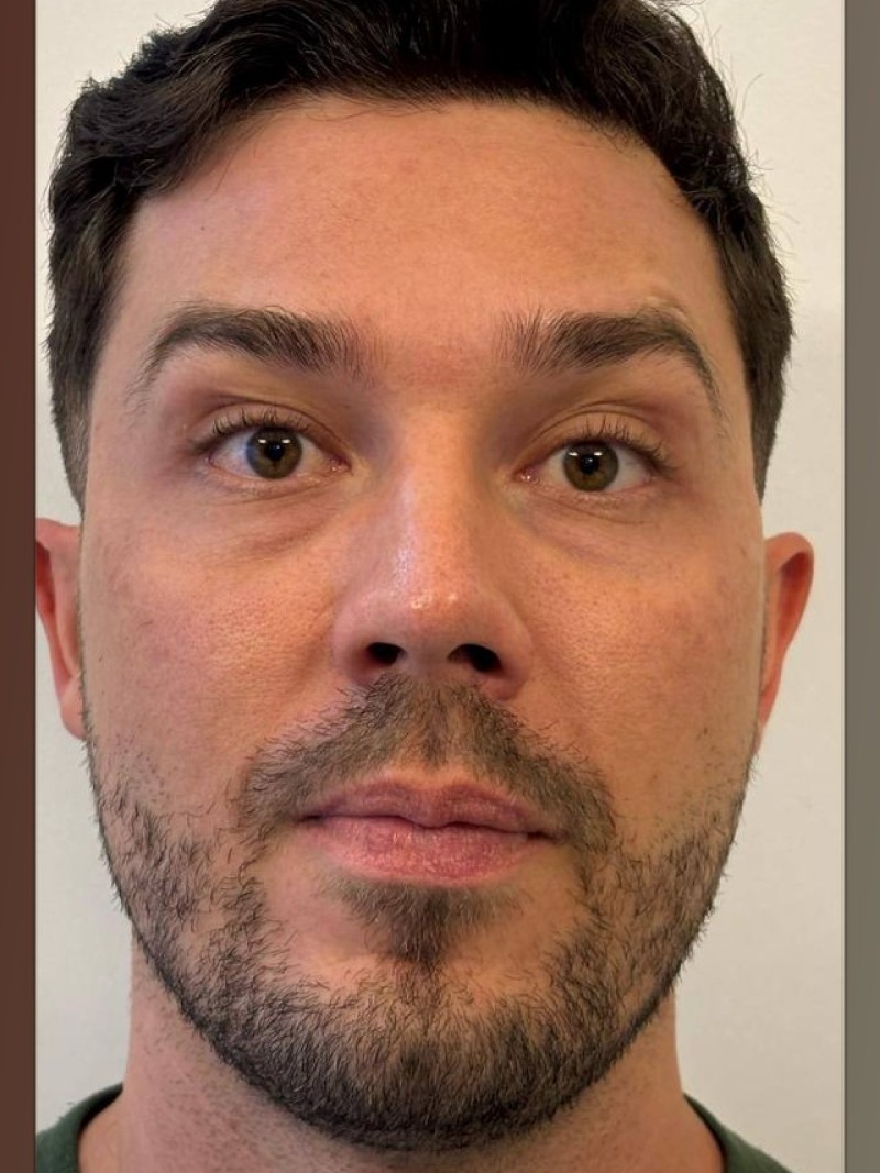 Antes e depois, caso 2, depois