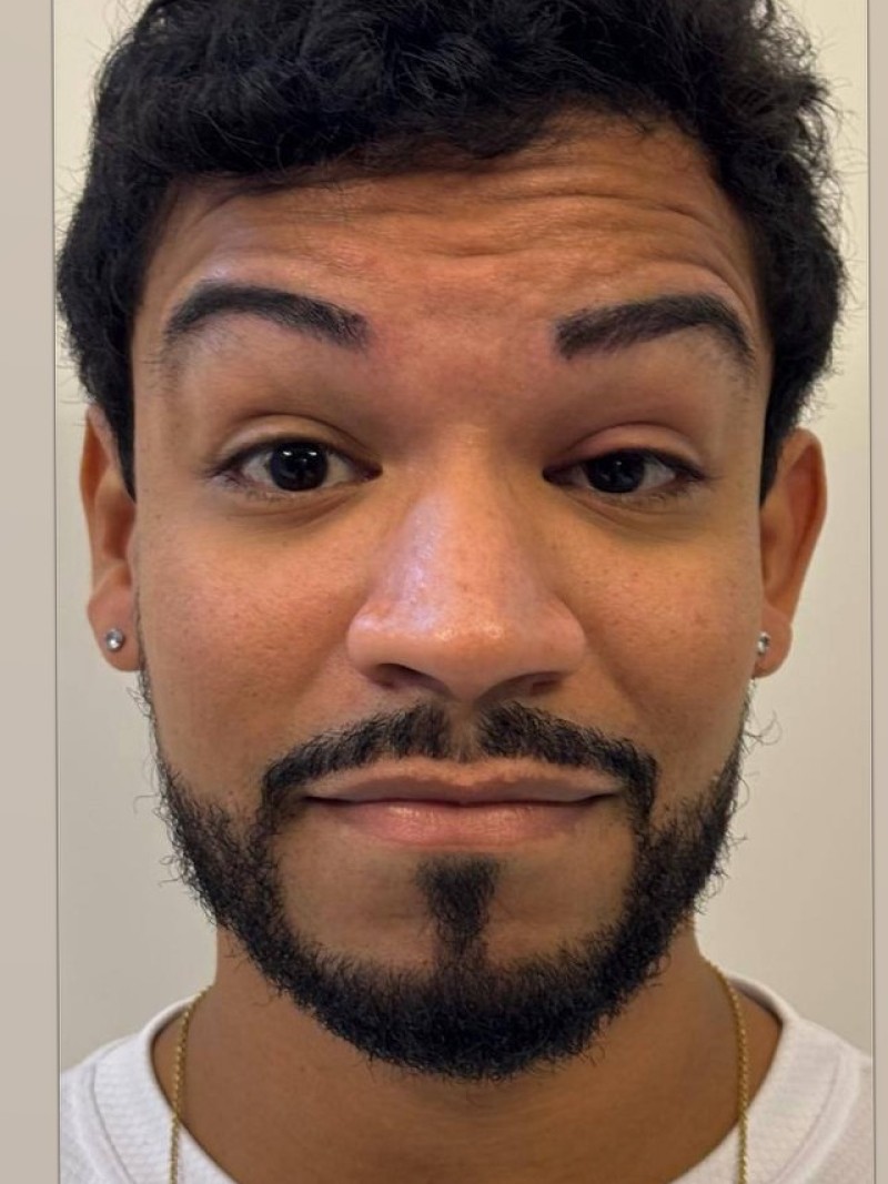 Antes e depois, caso 3, antes