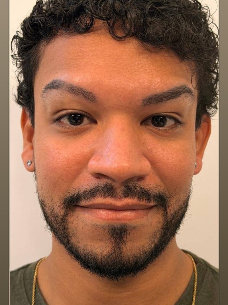 Antes e depois, caso 3, depois