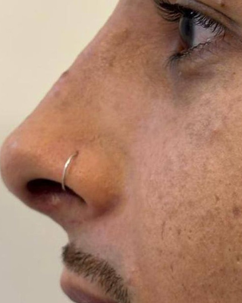 Perfil do nariz, caso 2, depois